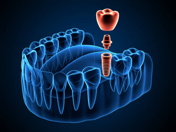 Implantologie orala